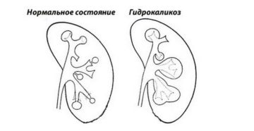 Гидрокаликоз левой почки причины