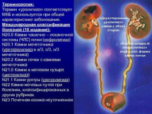 Стриктура мочеточника мкб
