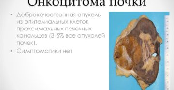 Диагностика онкоцитома почки