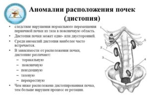 Аномалии расположения почек дистопия