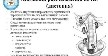 Аномалии расположения почек дистопия