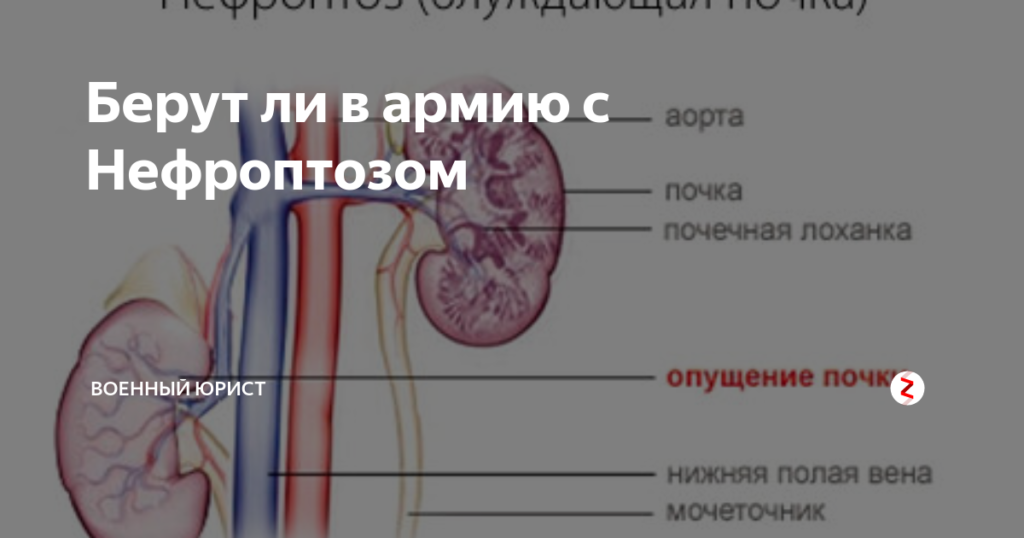 Нефроптоз берут ли в армию