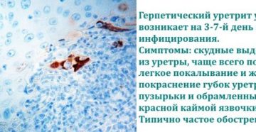 Уретрит от герпеса
