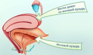 Матка давит на мочевой пузырь причины