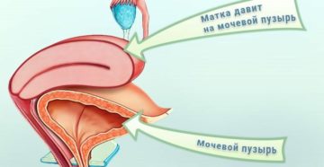 Матка давит на мочевой пузырь причины
