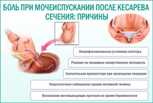 Мочевой пузырь болит после кесарева