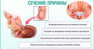 Мочевой пузырь болит после кесарева
