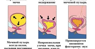 Недержание мочи у женщин после 30 лет причины и лечение