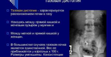 Тазовая дистопия почки у новорожденного