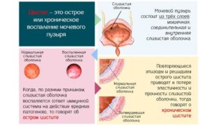 Цистит часто повторяется