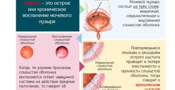 Цистит часто повторяется