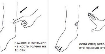Как распознать отеки