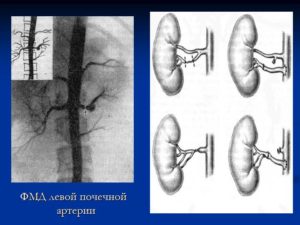 Пиеловазальный конфликт почек лечение