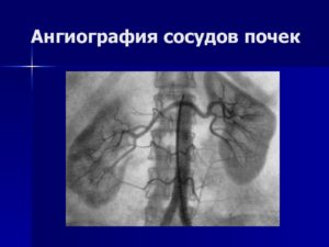 Как проверить сосуды в почках