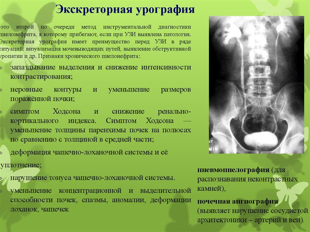 Экскреторная урография описание