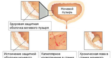 Лечится ли хронический цистит