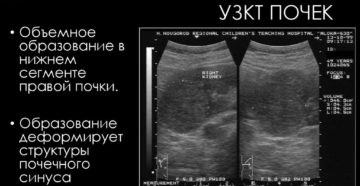 Образование почки диагностика