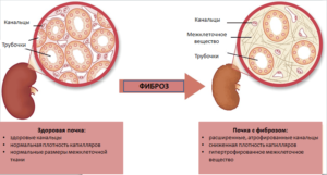 Фиброзная ткань в почках