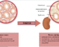 Фиброзная ткань в почках