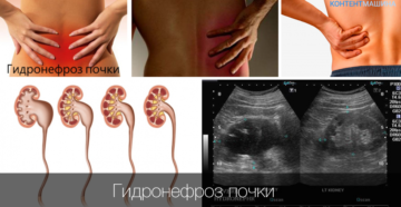 Одна почка увеличена что это значит