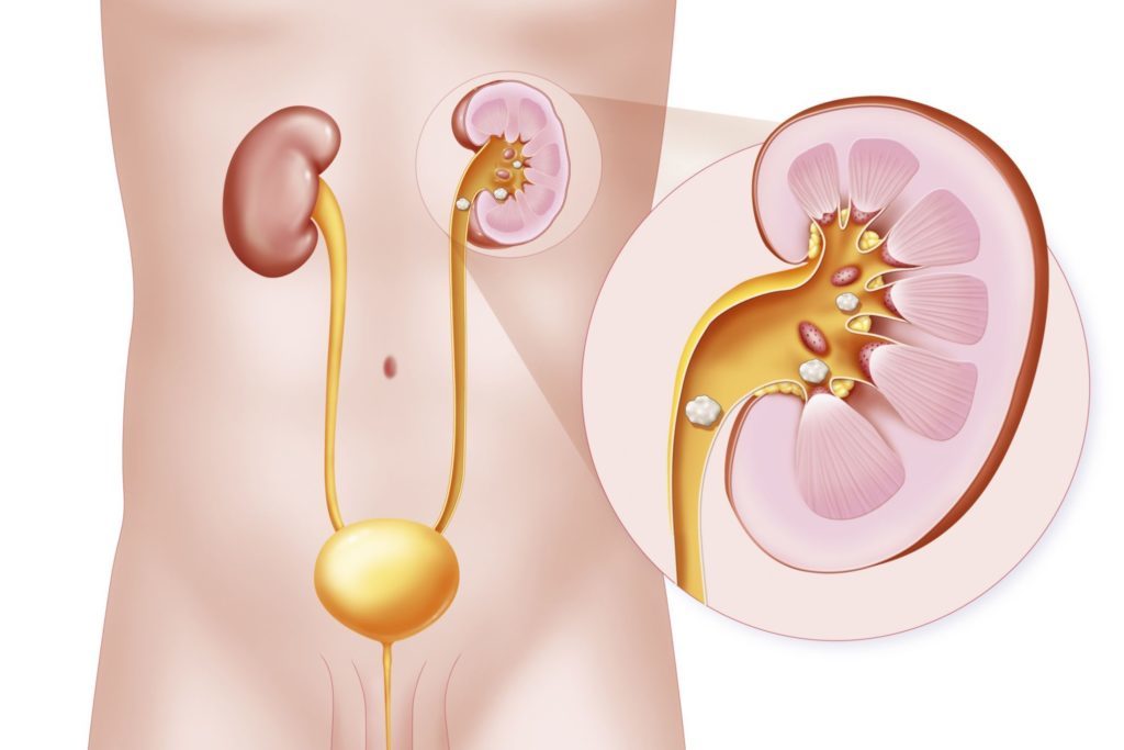 Обструкция в почке