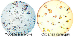Кристаллы в моче при беременности