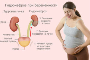 Как болит почка левая симптомы при беременности