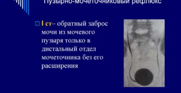 Заброс мочи из мочевого пузыря в почки у детей