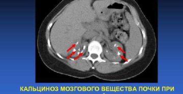 Обызвествление почки что это такое