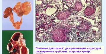 Кистозная дисплазия почки плода