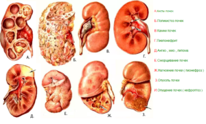 Патология почек что это
