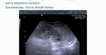Верхний полюс почки по узи
