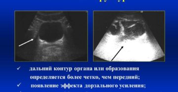 Анэхогенное что значит
