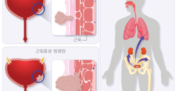 Больно писать женщине и кровь в моче