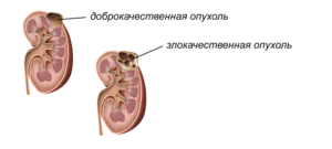 Что значит новообразование на почке