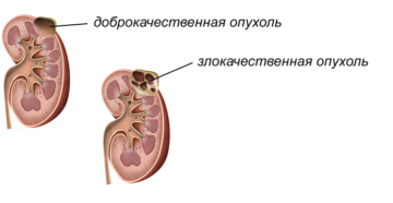 Что значит новообразование на почке
