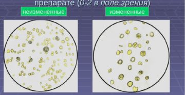 Что значит эритроциты в моче единичные