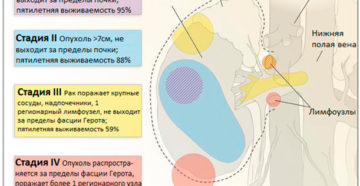 Излечим ли рак почки 1 стадии