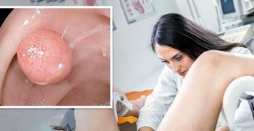 Лечение полипа на входе в уретру народными средствами