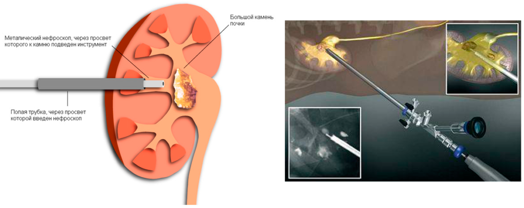 Как удаляют камень в почках