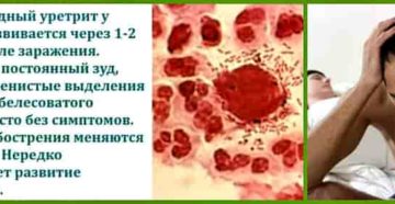 Стрептококковый уретрит у мужчин