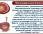 Цистит на фоне мочекаменной болезни