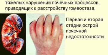 Тяжелая почечная недостаточность