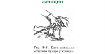 Техника катетеризации мочевого пузыря у женщин и мужчин