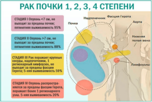 Рак почки 3 степени сколько живут