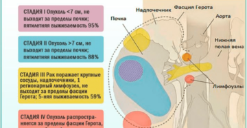 Рак почки 3 степени сколько живут