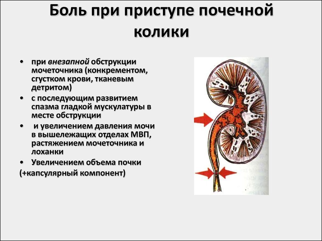 Приступ почек симптомы