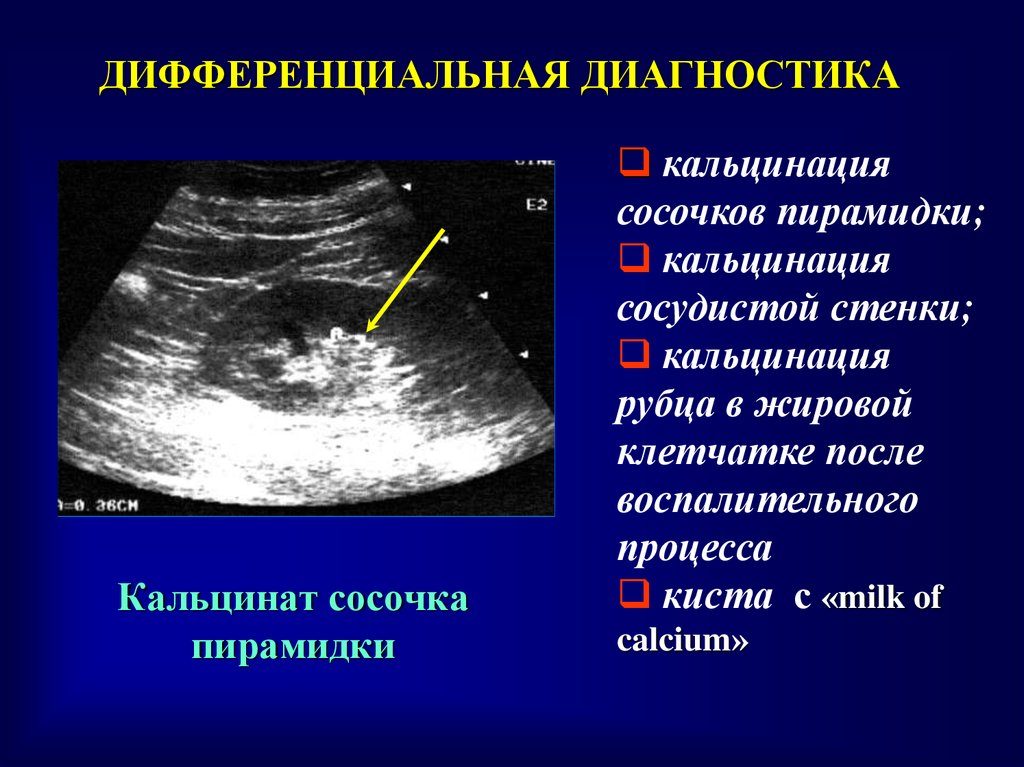 Кальциноз пирамидок почек что это такое