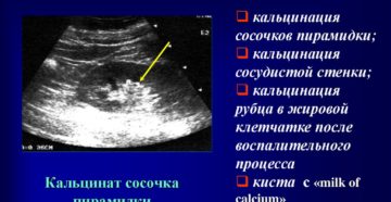 Кальциноз пирамидок почек что это такое