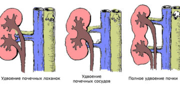 Внутрипочечное удвоение члс
